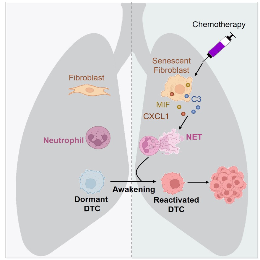 Nuevo estudio relaciona la quimioterapia con propagación de cáncer de&nbsp;mama
